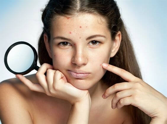 acne tras el verano|Tratamiento combinado que limpia, oxigena, hidrata y elimina el acné.