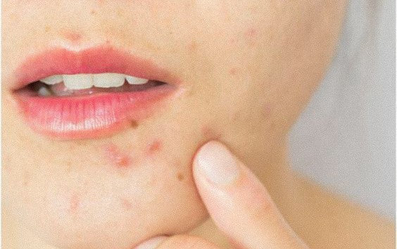 acne tras el verano