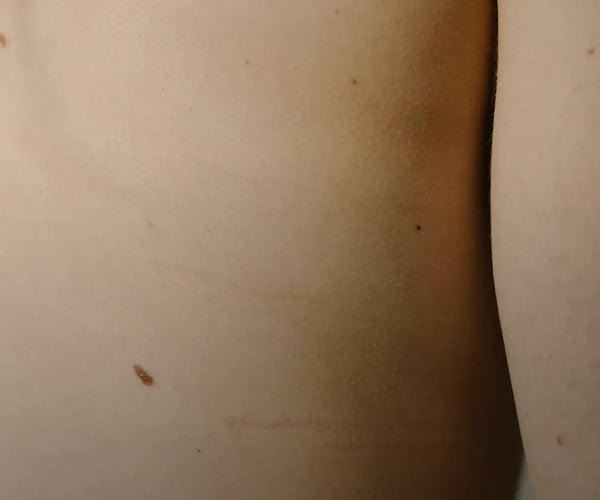 Celulitis